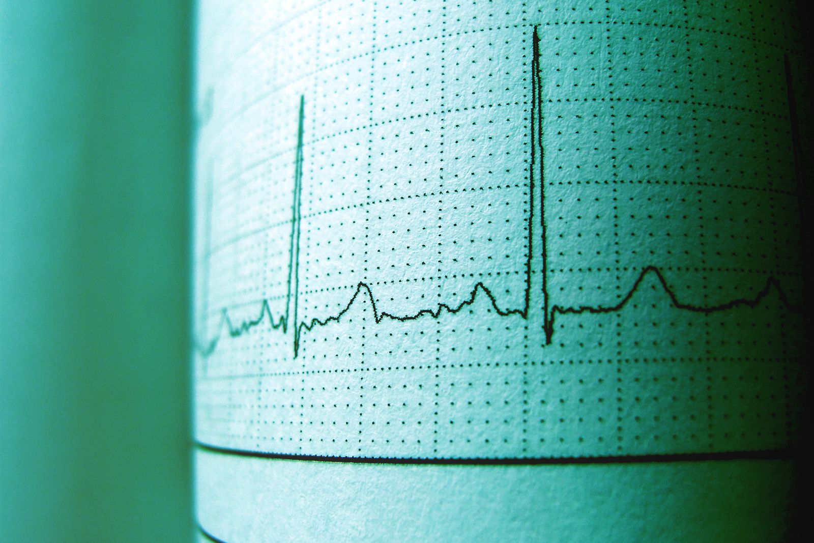 Electrocardiogram trace on recording paper, the record electrophysiology expert witnesses interpret