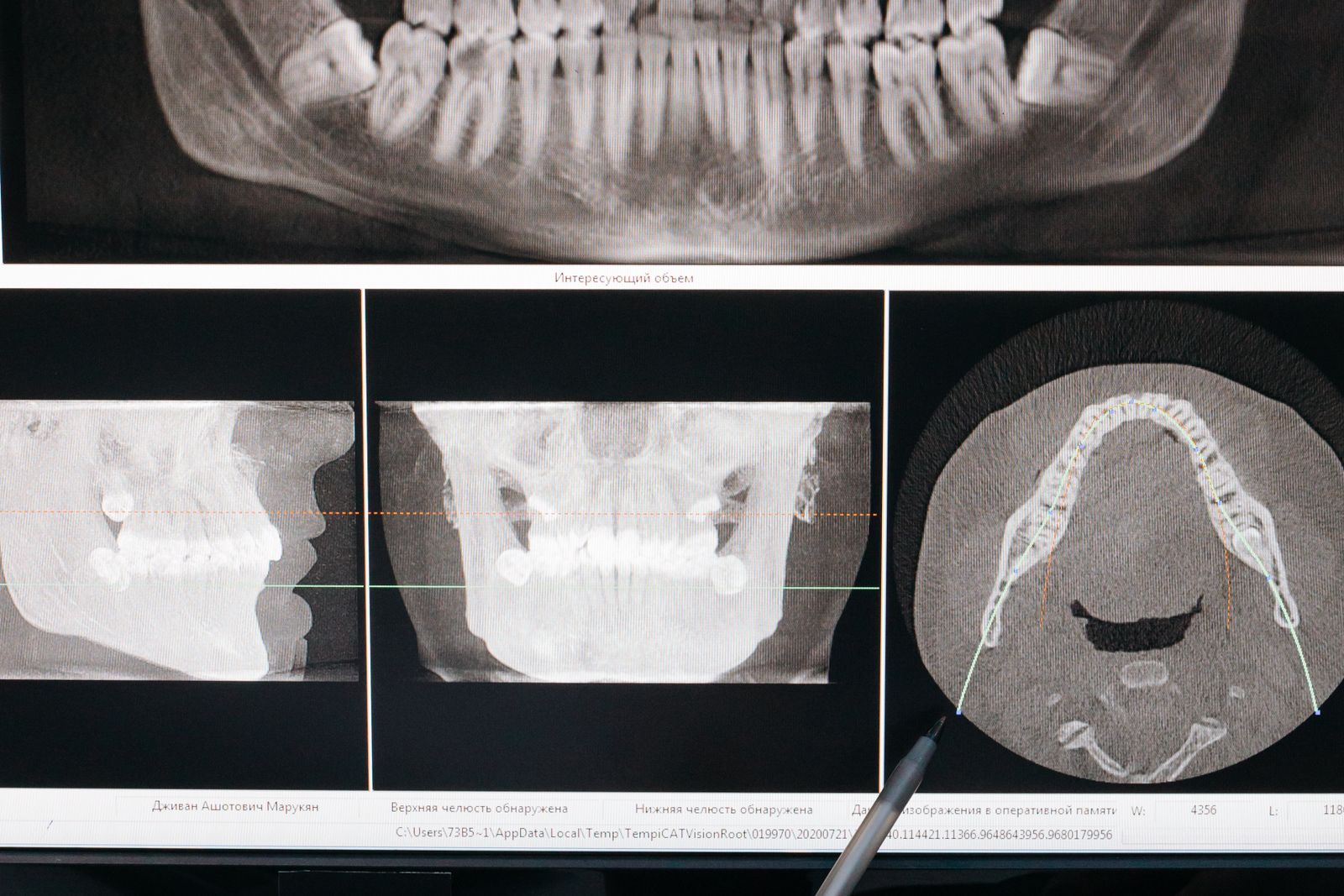 Dental imaging workstation showing jaw radiographs, the material forensic odontology expert witnesses analyse