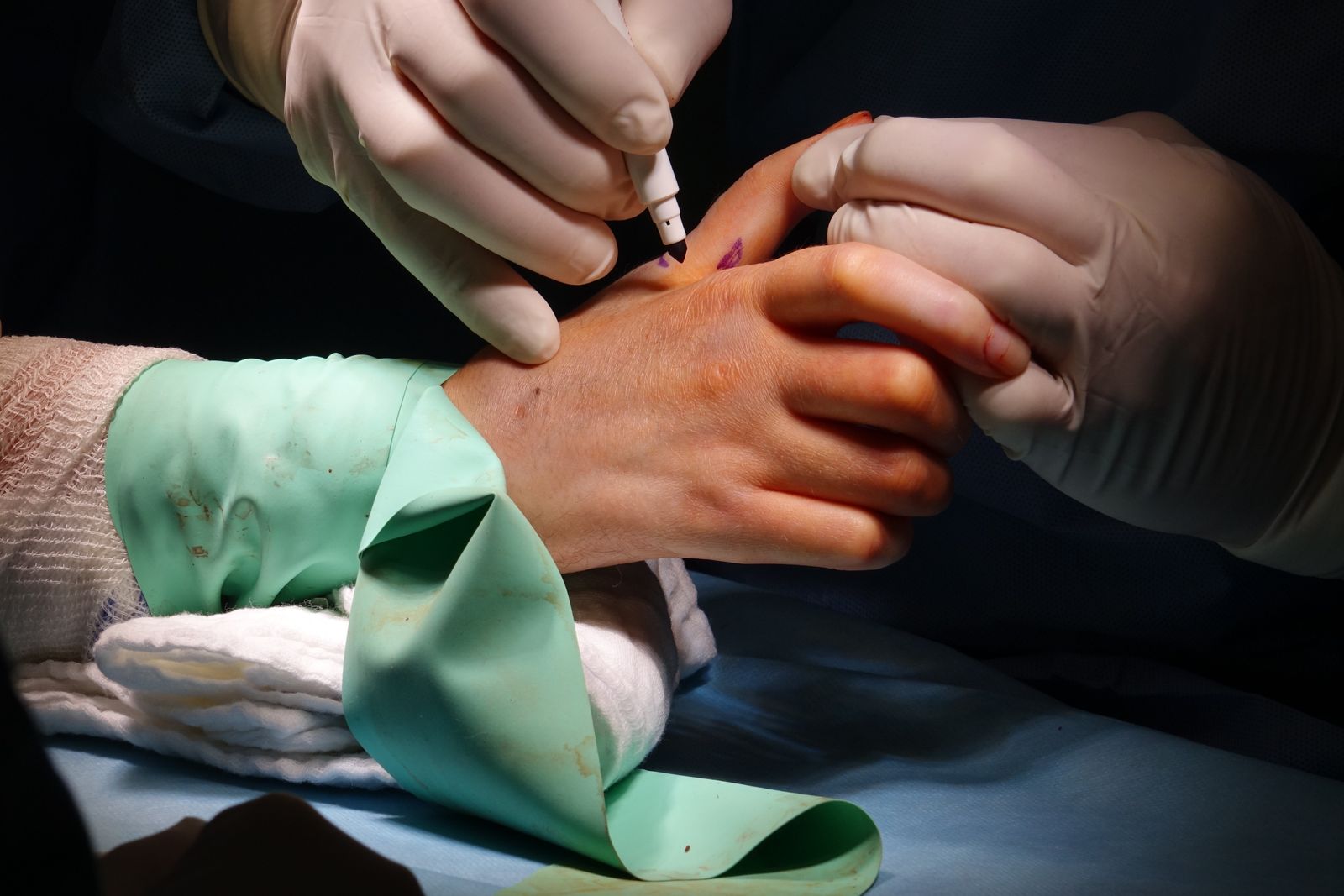 Surgeon marking a patient’s hand before an operation, the practice hand surgery expert witnesses assess