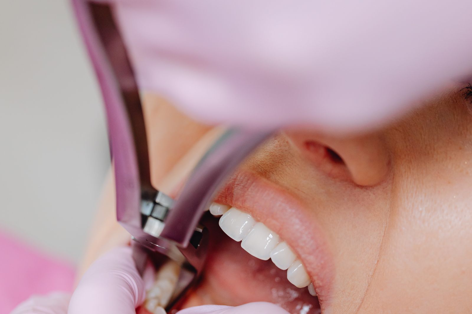 Dental extraction being performed with forceps, the practice oral surgery expert witnesses examine