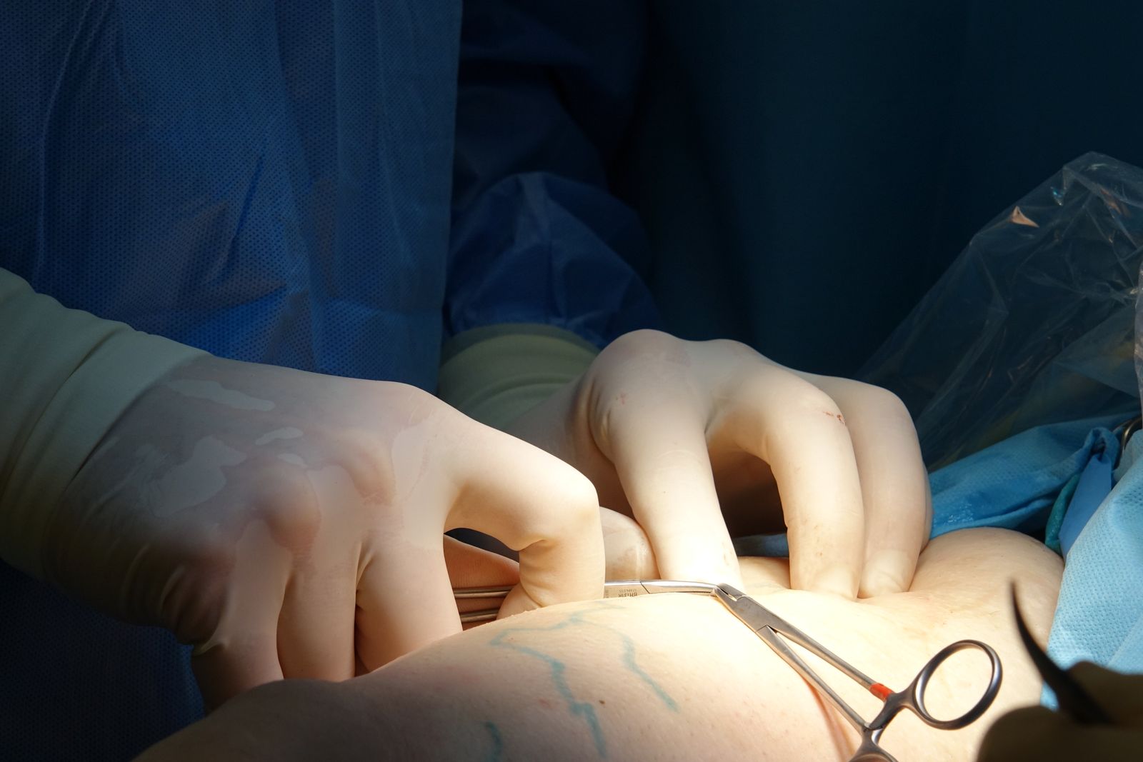 Thoracic surgeon expert witness — Surgical hands and instruments over a draped operative field, the practice thoracic surgery expert witnesses examine
